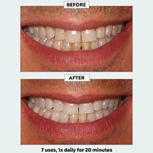 Intelliwhite Blue32 Whitening Kit
