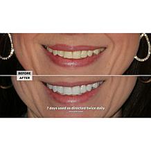 Intelliwhite Platinum Pen Whitening Kit with Turbo Boost