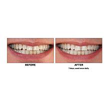 Intelliwhite TRIPULSE Teeth Whitening System