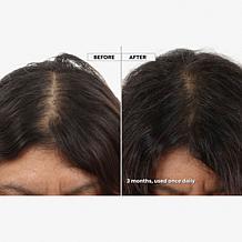 Keranique 120-Day Hair Regrowth Bundle Auto-Ship®