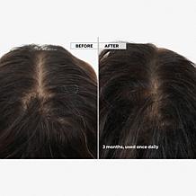 Keranique 120 Day Hair Regrowth Bundle