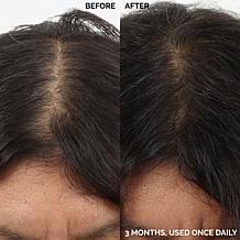 Keranique 120 Day Hair Regrowth Foam Bundle Auto-Ship®