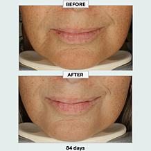 Metamorphosis Light Therapy LushLips Transformation LED Lip + Perio...