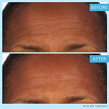 Skinn® Cosmetics DermAppeal® Microderm Beauty Treatment