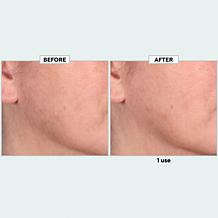 TruRitl Dermaplane Set w Bag