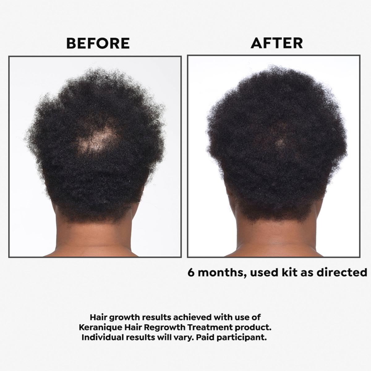 Keranique 90-Day Hair Regrowth System Auto-Ship® - 20845097 | HSN Keranique 90-Day Hair Regrowth System Auto-Ship® - 20845097 | HSN